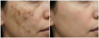 Before and after comparison showing dramatic improvement in facial skin pigmentation and dark spots through professional dermatological treatment.