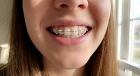 Young woman with metal braces smiling showing orthodontic treatment for dental care and teeth straightening in bright natural light.