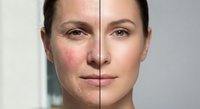 Woman face showing before and after skincare treatment results with clear skin transformation for beauty and cosmetic procedures.