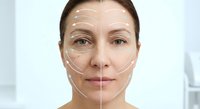 Young Caucasian woman with facial mapping lines showing cosmetic surgery or anti-aging treatment planning for medical and beauty industry applications.