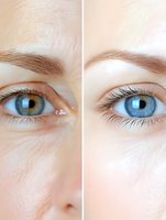 Close-up comparison of skin texture and eye appearance showing aging effects and beauty treatment results, highlighting differences in wrinkles and skin smoothness.