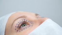 Woman receiving cosmetic eye treatment with blue dots marking injection points for anti-aging procedure at medical spa clinic.