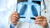 Medical professional examining chest x-ray film showing lungs and ribcage, wearing white coat. Healthcare diagnostic screening for respiratory conditions.