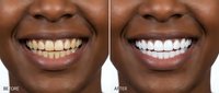 African American woman smiling showing teeth whitening transformation before and after comparison for dental care and cosmetic dentistry procedures.