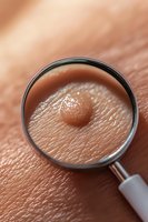 Magnifying glass examining skin texture and pore closeup on human epidermis, showing detailed dermatological features for medical and skincare concepts.