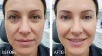 Before and after cosmetic treatment showing middle-aged Caucasian woman with dramatic skin rejuvenation and wrinkle reduction results in clinical setting.