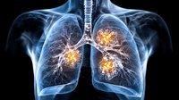 Glowing orange spots in translucent blue human lungs and bronchi showing inflammation or disease areas in medical visualization on black background.