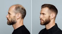 Before and after hair transplant comparison showing Caucasian male with beard in profile view, demonstrating successful restoration of receding hairline and crown area.
