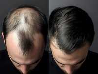 Male hair loss treatment before and after comparison showing dramatic hair restoration results on Caucasian man with thick dark hair regrowth transformation.
