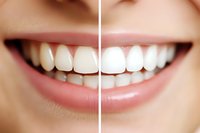 Before and after comparison of teeth whitening treatment showing dramatic improvement in dental color from yellow to bright white, highlighting professional results.