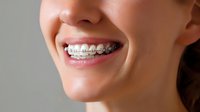 Close up view of bright smile with metal orthodontic braces showing white teeth and pink lipstick against soft neutral background, dental care concept.