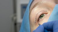 Young woman receiving eyelid surgery consultation with surgeon marking incision lines for blepharoplasty procedure in modern medical clinic.
