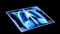 Medical x-ray scan showing chest bones and ribs illuminated in bright neon blue color against dark background, modern digital healthcare visualization for medical design.