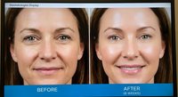 Young Caucasian woman showing dermatological treatment results with before and after comparison for skincare and cosmetic procedures.