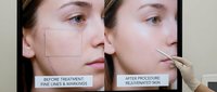 Professional skincare treatment comparison showing woman's face before and after cosmetic procedure with visible skin texture improvement and rejuvenation results.