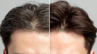 Before and after hair restoration treatment showing significant improvement in hairline density and coverage for male pattern baldness.