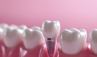 Dental implant crown between natural teeth on pink background, showing modern tooth restoration and prosthetic dentistry technology for oral health care.