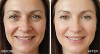 Middle-aged Caucasian woman face before and after anti-aging skincare treatment showing wrinkle reduction and skin rejuvenation results.