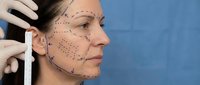 Middle-aged Caucasian woman with surgical markings on face for cosmetic procedure planning. Medical consultation for facial rejuvenation surgery preparation.