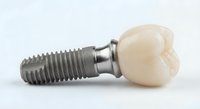 Dental implant with ceramic crown isolated on white background showing titanium screw and tooth restoration for oral surgery and dentistry procedures.