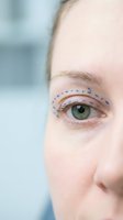 Close-up of woman's eye with blue surgical markings for cosmetic eyelid surgery procedure in medical clinic setting for blepharoplasty consultation.